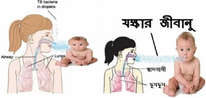 শিশুদের যক্ষ্মা
