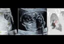 মায়ের পেটেই শিশুর অস্ত্রোপচার! বিশ্ব যা পারেনি, চীন করে দেখাল
